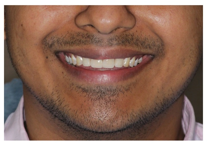 Smile Makeover After