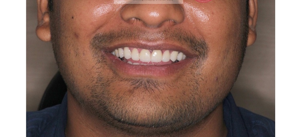 Diastema Gap Closure After