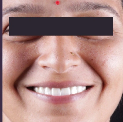 Aesthetic Smile Transformation After