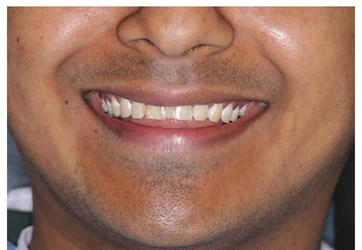 Smile Makeover Before