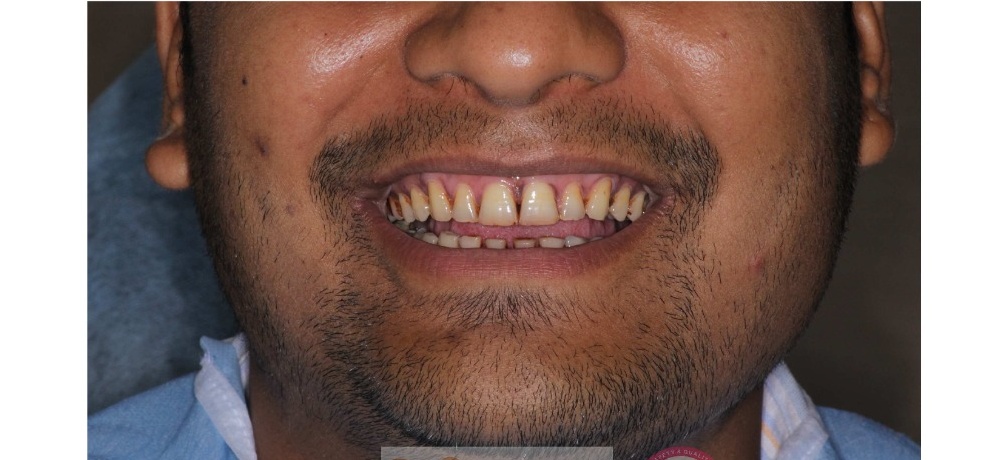 Diastema Gap Closure Before