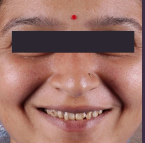 Aesthetic Smile Transformation Before