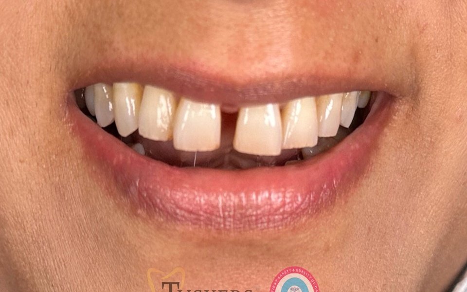 Damaged Tooth Before Crown