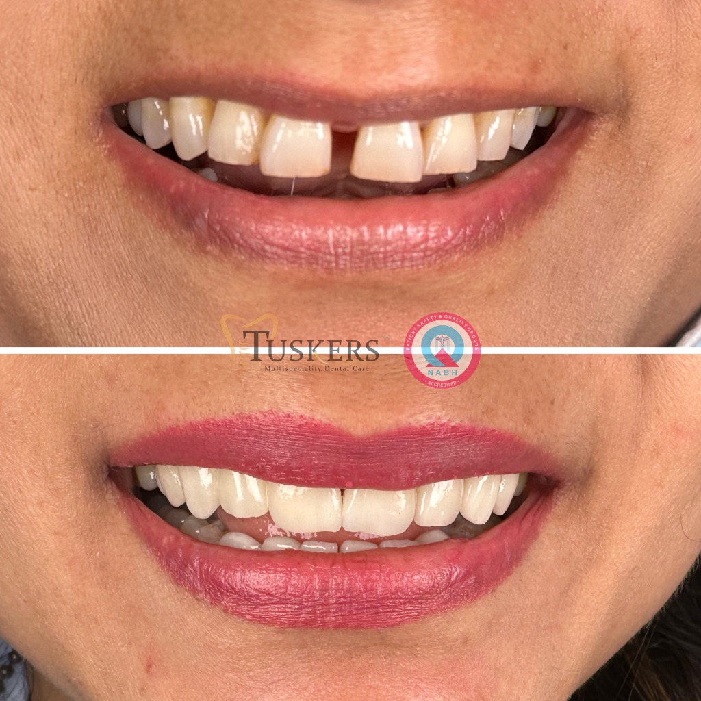 Tuskers Crowns and Bridges Full Smile Restoration Result
