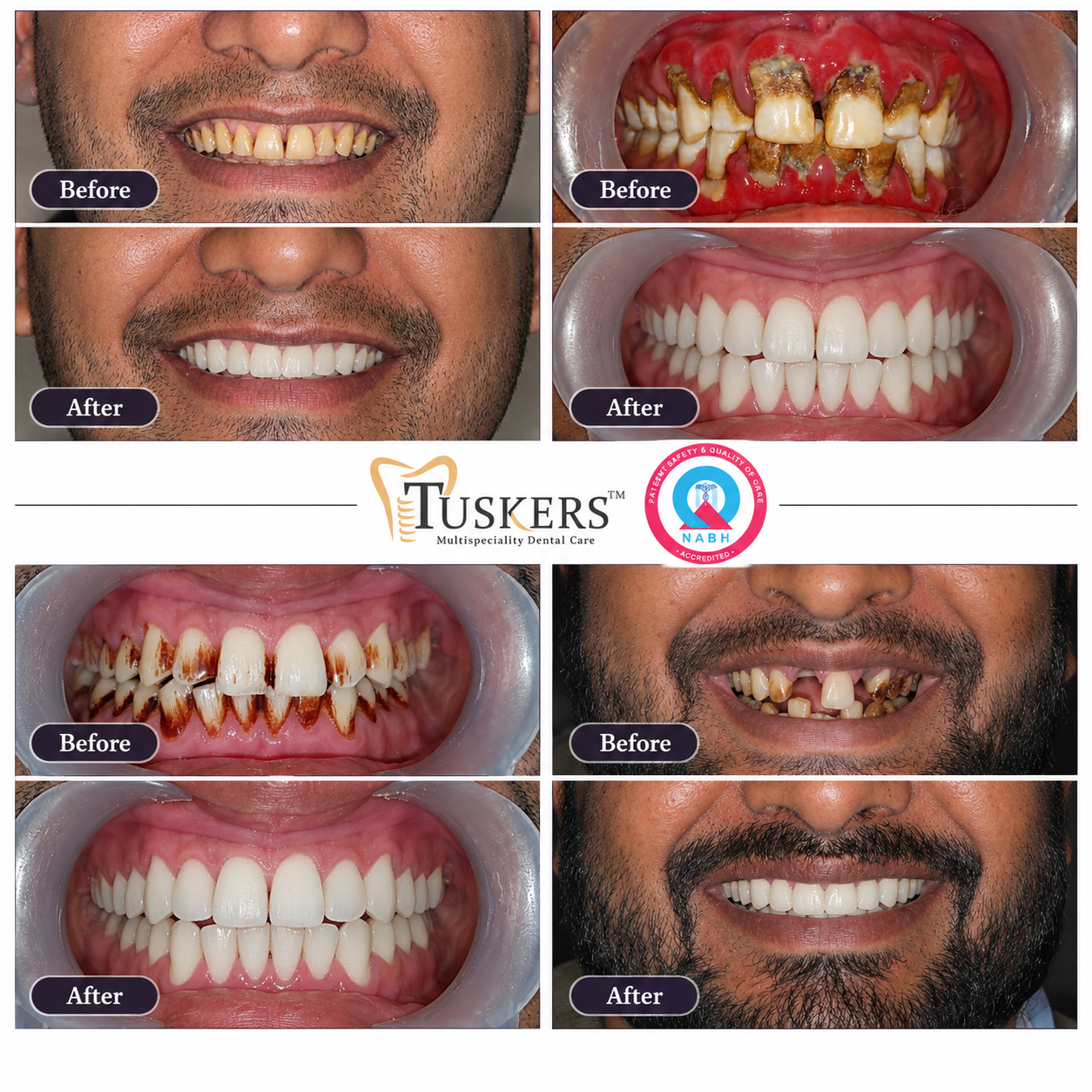 Tuskers Periodontal Gum Treatment Transformation Before & After