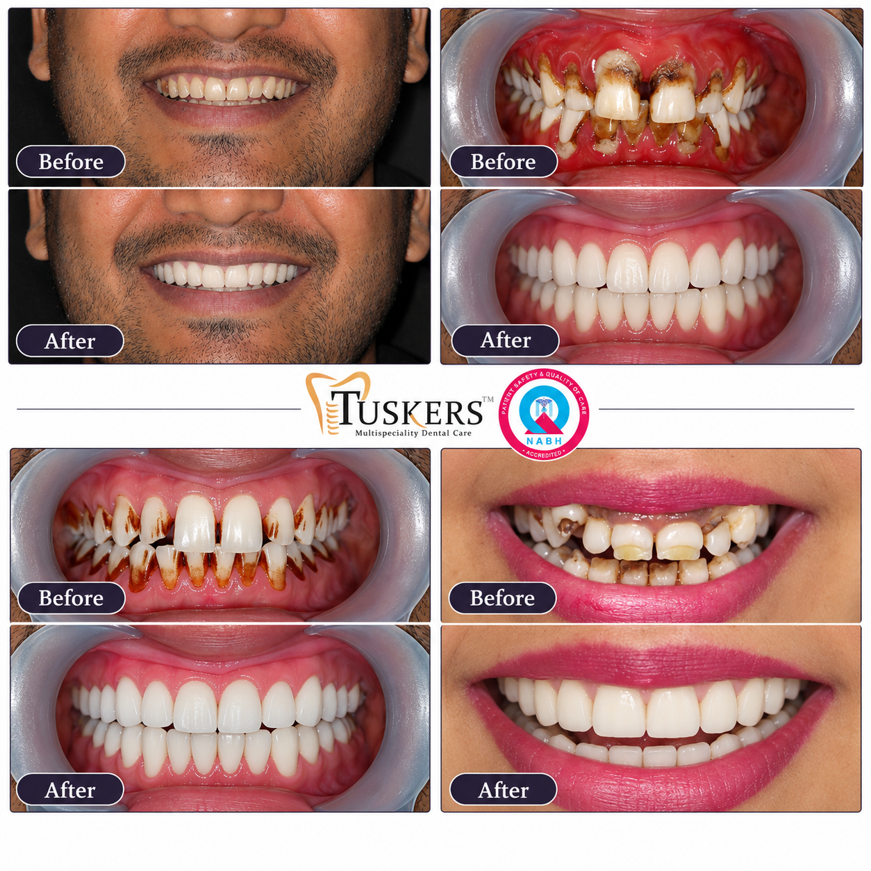 Tuskers Clinical Smile Makeover Before & After Transformation Result