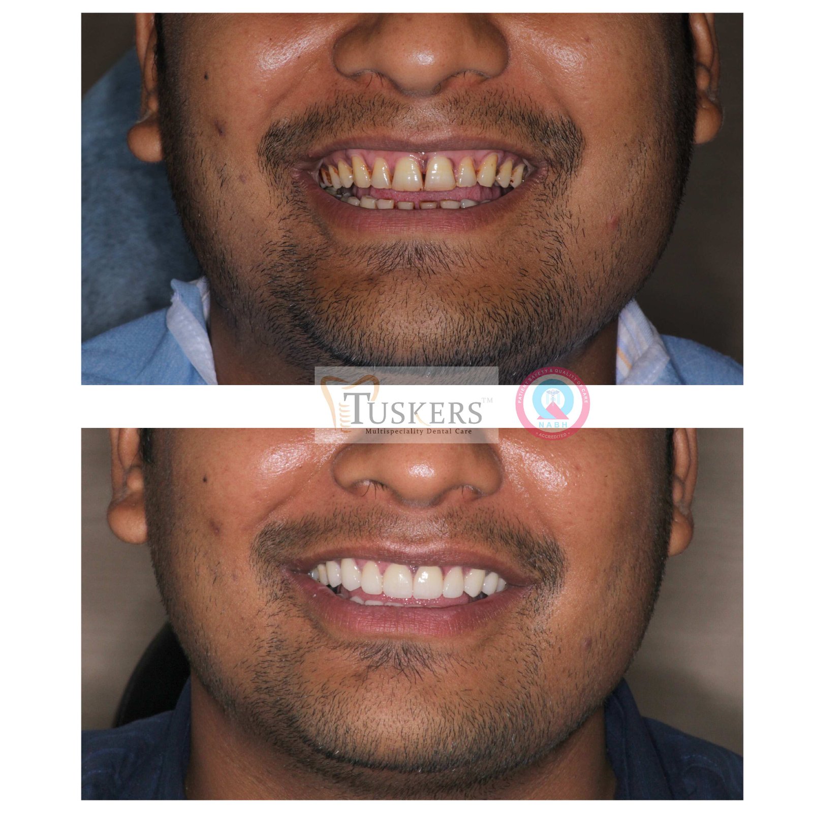 Tuskers Clinical Case - Root Canal Treatment & Full Smile Restoration