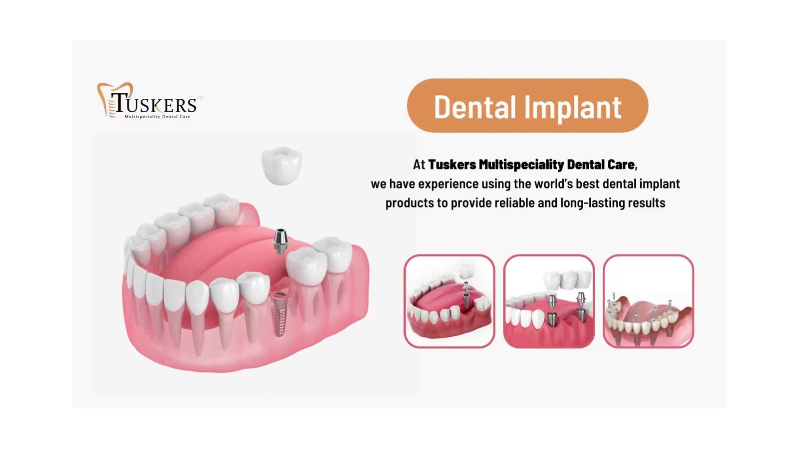 Dental Implant Procedure Guide