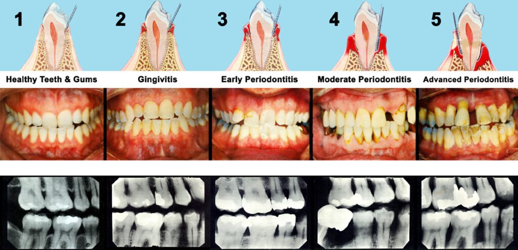 Gum Disease Treatment Treatment Of Pyorrhea 7239